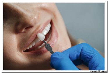لمینت دندان در کلینیک دندانپزشکی دکتر صنفی