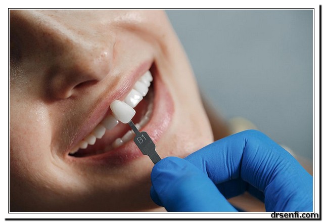 لمینت دندان در کلینیک دندانپزشکی دکتر صنفی