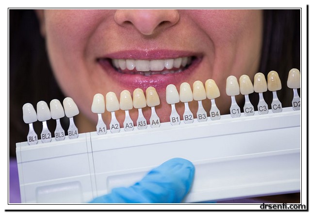 نحوه‌ی ساخت لمینت متحرک دندان :