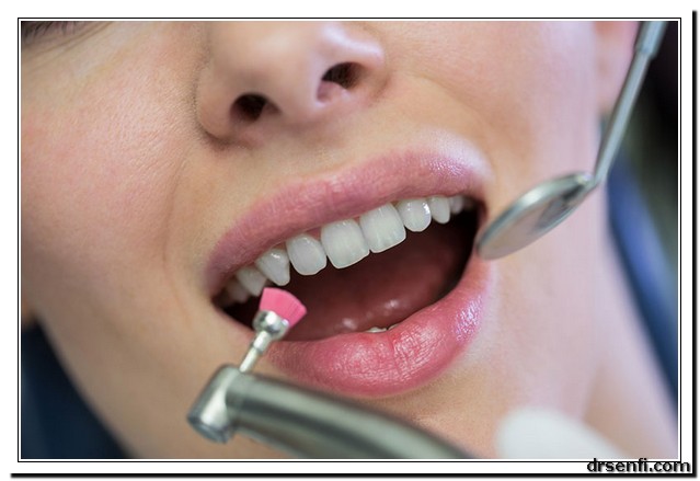 مراحل لمینت دندان