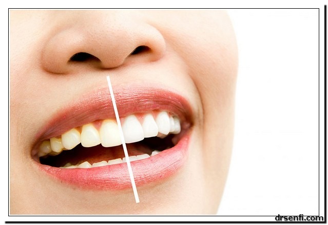 انواع لمینت دندان در کلینیک دندان پزشکی دکتر صنفی