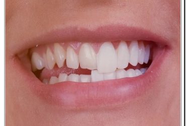 لمینت دندان کج در کلینیک دندانپزشکی دکتر صنفی