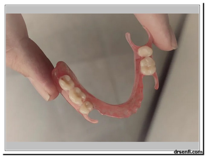 دندان مصنوعی چسبی چیست