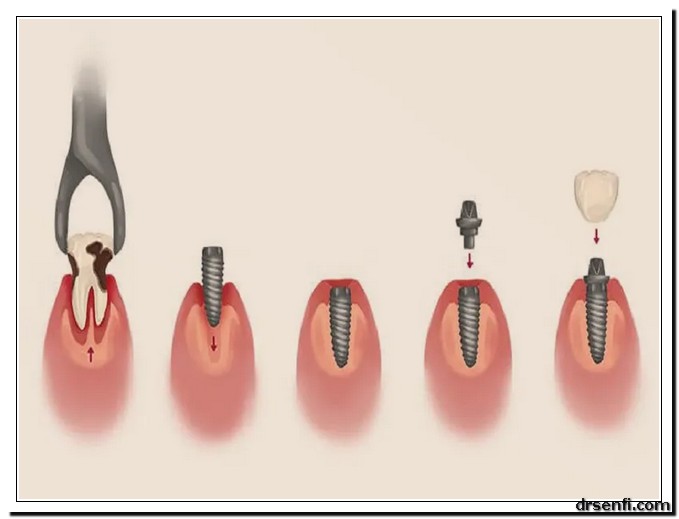 مراحل ایمپلنت دندان کلینیک دندانپزشکی دکتر صنفی
