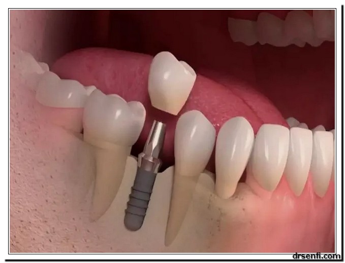 ایمپلنت دندان کلینیک دندانپزشکی دکتر صنفی
