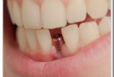 ایمپلنت دندان جلویی کلینیک دندانپزشکی دکتر صنفی