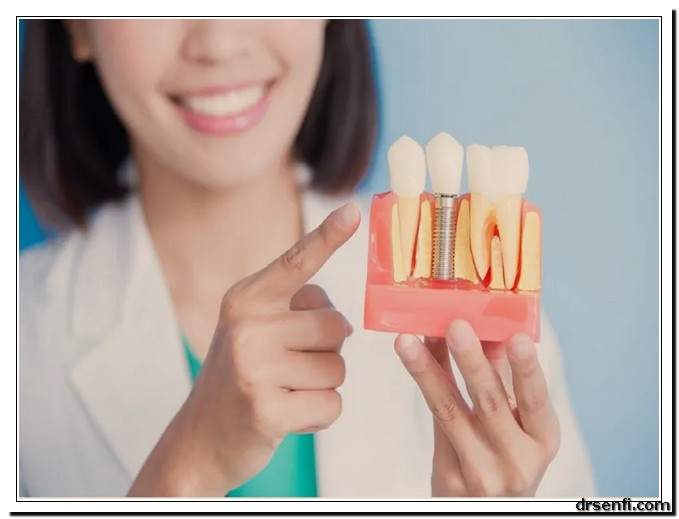 مقایسه‌ی دندان چسبی و ایمپلنت