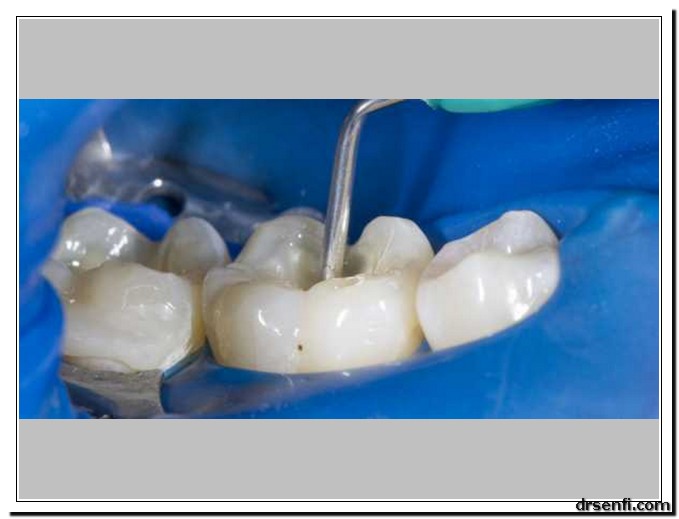 درمان ریشه دندان در کلینیک دندانپزشکی دکتر صنفی