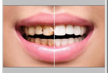 انواع کامپوزیت در کلینیک دندانپزشکی دکتر صنفی