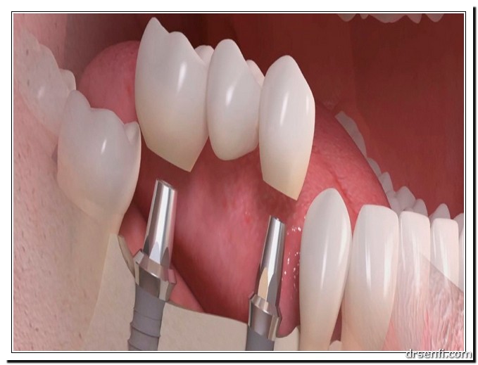 جراحی ایمپلنت دندان چقدر زمان بر است؟
