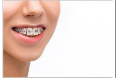 هزینه ارتودنسی در کلینیک دندانپزشکی دکتر صنفی