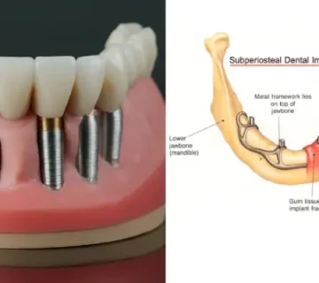 ایمپلنت فوری