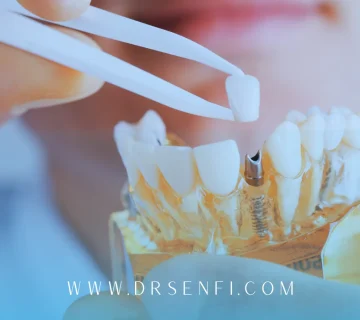 چند جلسه برای ایمپلنت لازم است؟