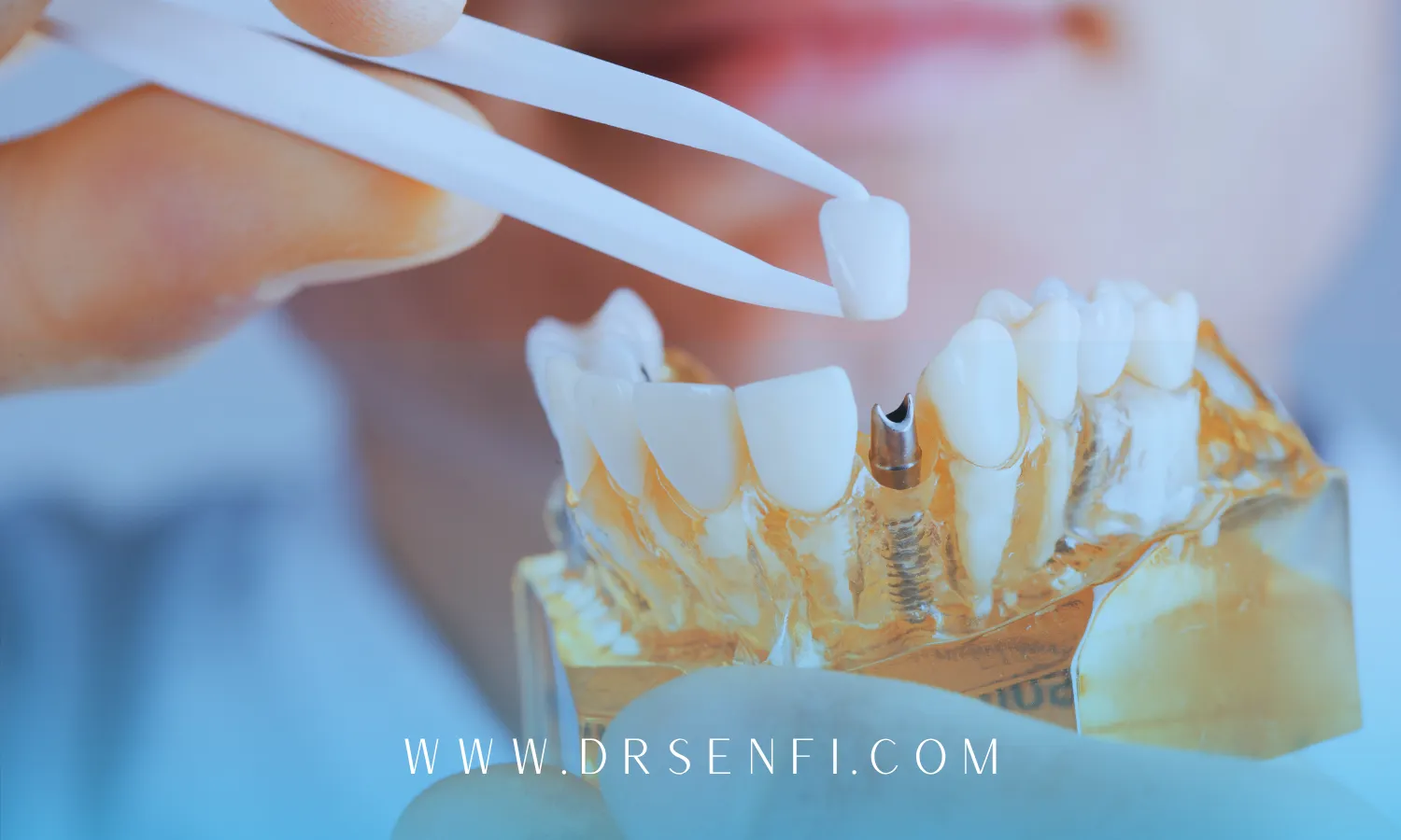 چند جلسه برای ایمپلنت لازم است؟