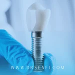 چند جلسه برای ایمپلنت لازم است؟