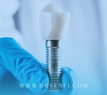 چند جلسه برای ایمپلنت لازم است؟