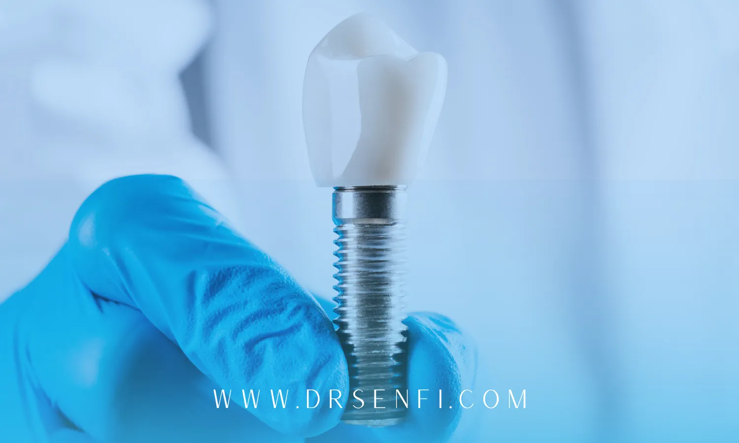 چند جلسه برای ایمپلنت لازم است؟